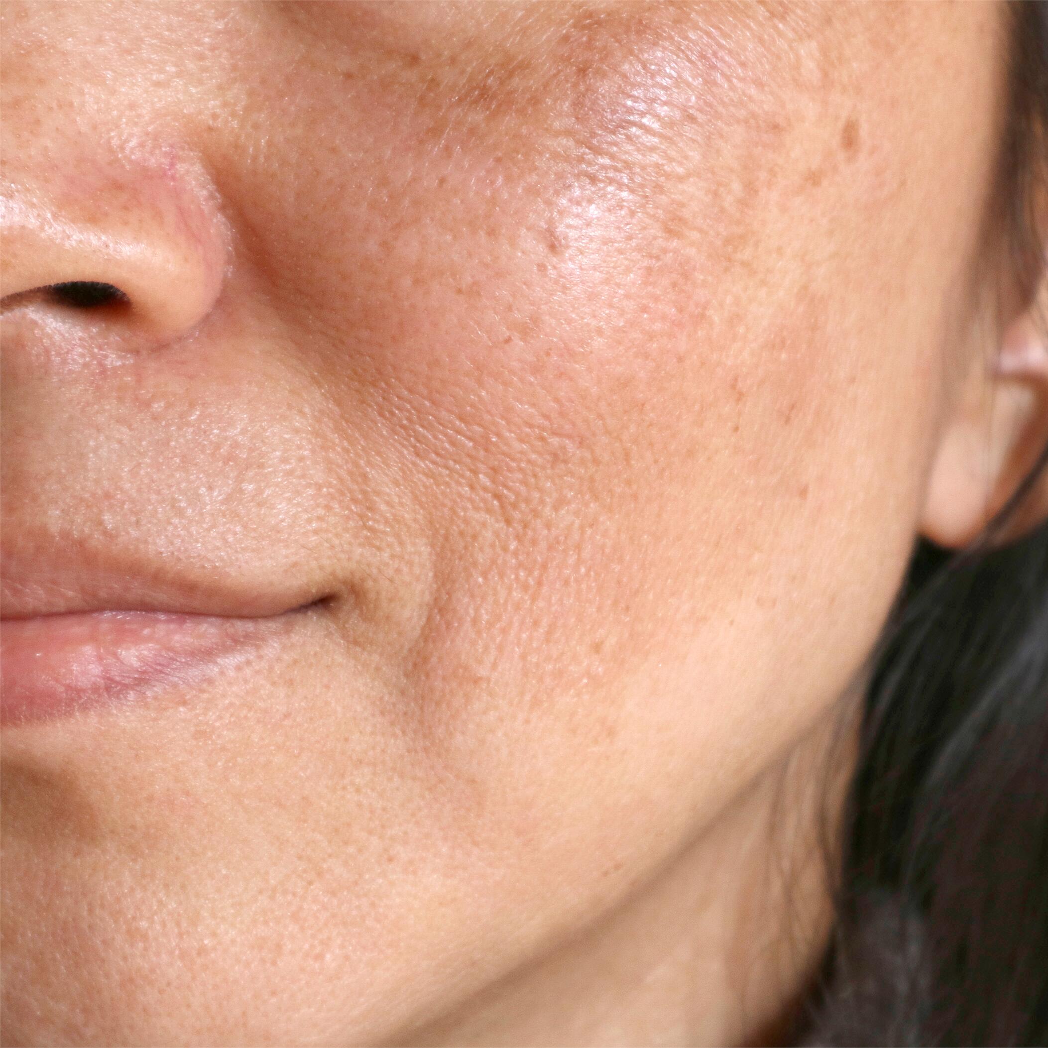 taches brunes caussées par le soleil